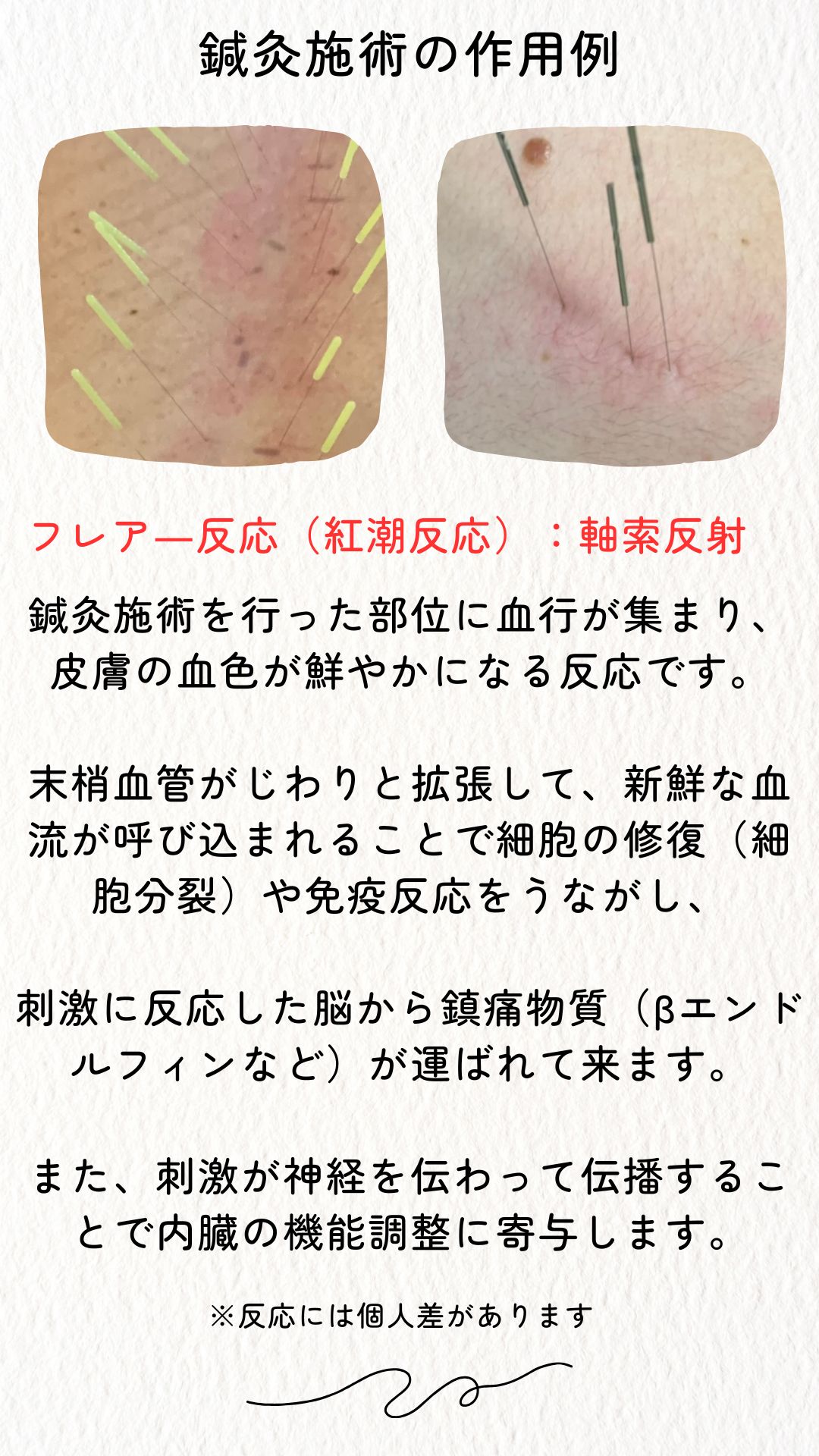 鍼灸施術によるフレアー反応などの作用例